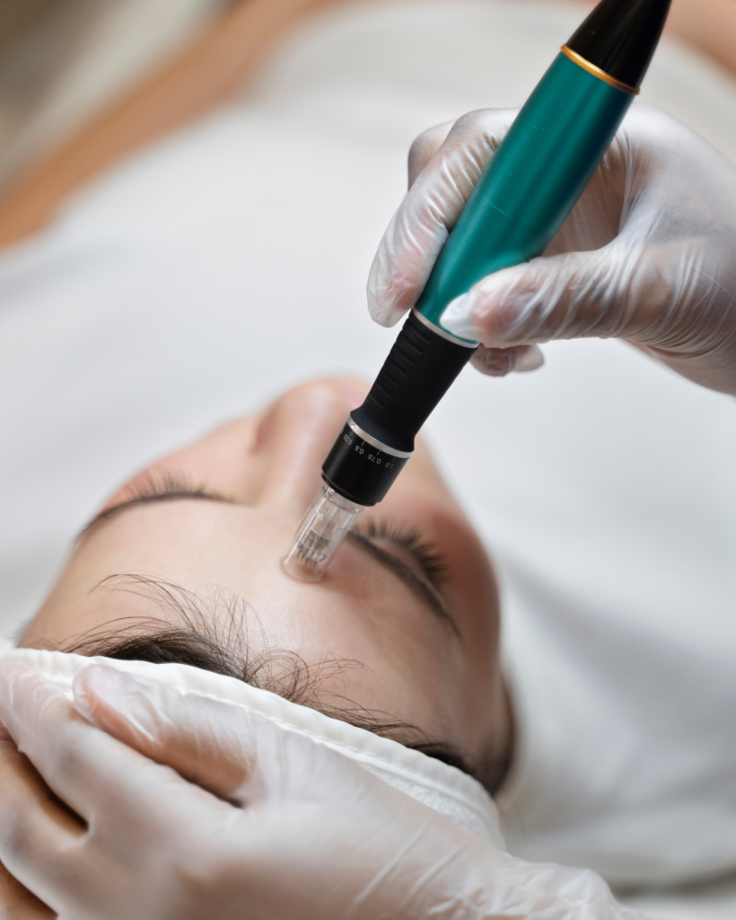 Microneedling 1
