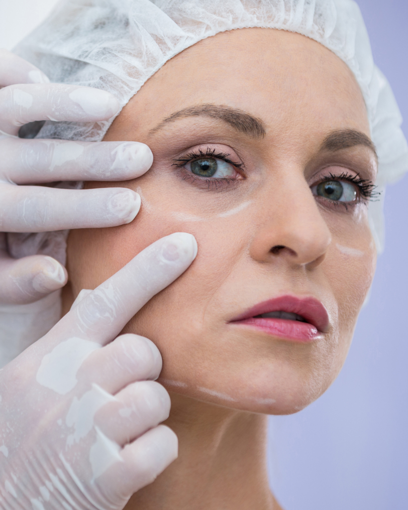 Morpheus8 Treatment 1