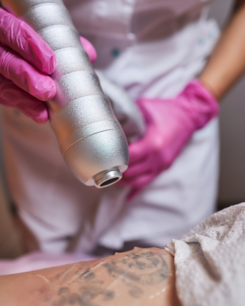 Tattoo removal